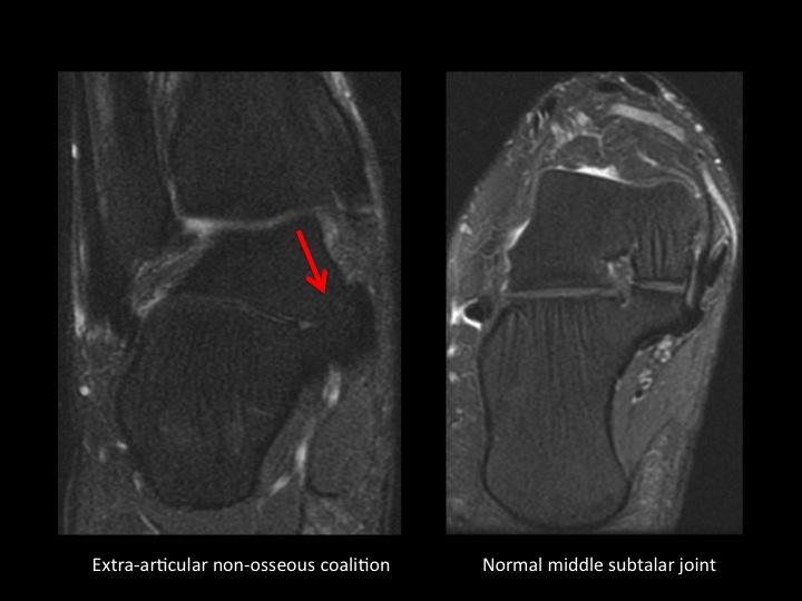 Figure 2 for case talocalcaneal joint ( RID3030 )